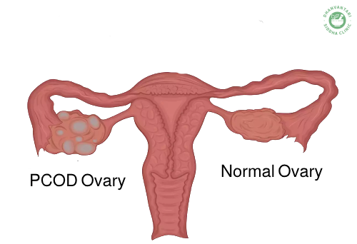 PCOD,PCOS Kit